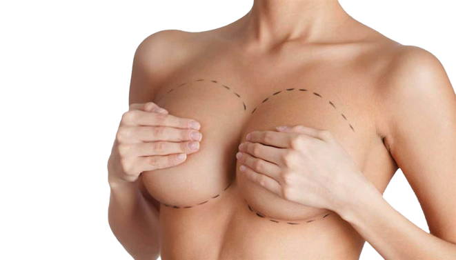 Breast Augmentation at Vilva Cosmetics