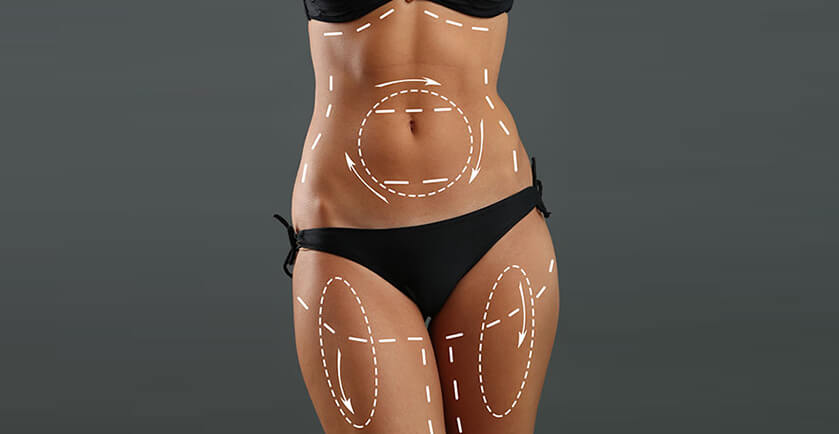 Liposuction at Vilva Cosmetics