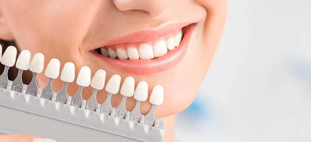 Dental Veneers at Vilva Cosmetics