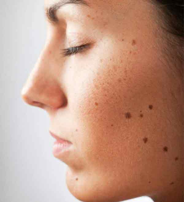 Surgical Mole Removal at Vilva Cosmetics