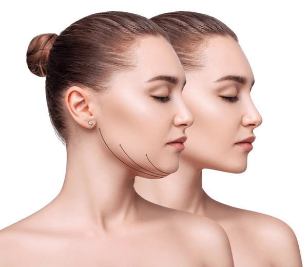 Chin & Cheek Reshaping at Vilva Cosmetics