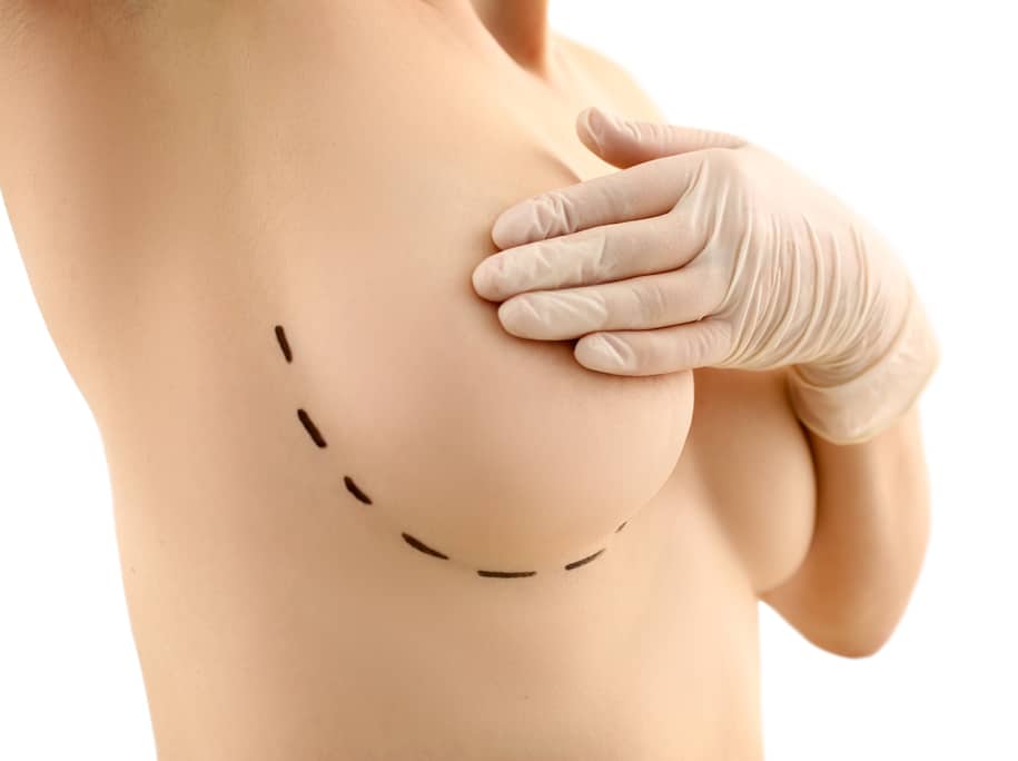 Breast Reduction at Vilva Cosmetics