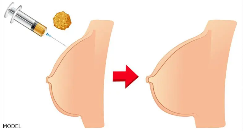 Breast Fat Transfer