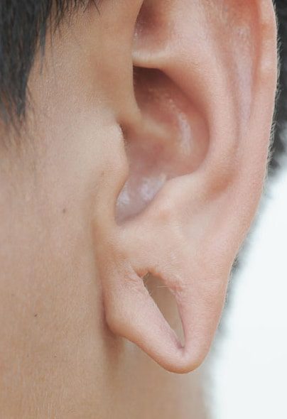 Earlobe Correction at Vilva Cosmetics