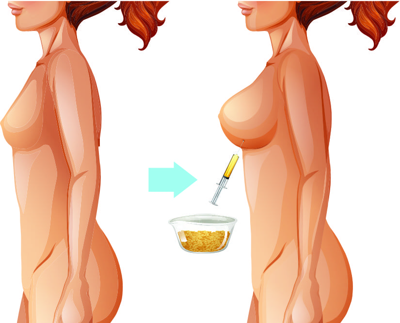 Breast Fat Transfer at Vilva Cosmetics