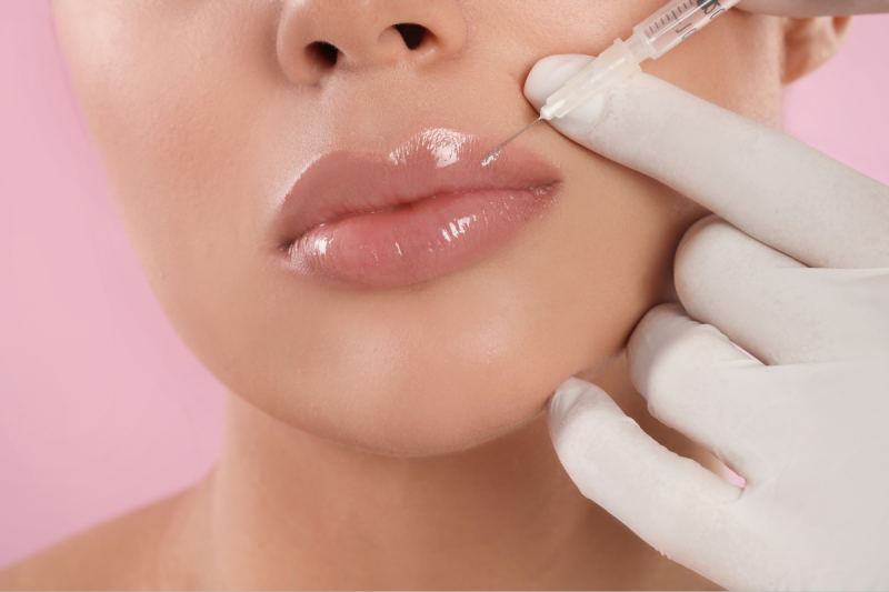 Lip Filler procedure at Vilva Cosmetics