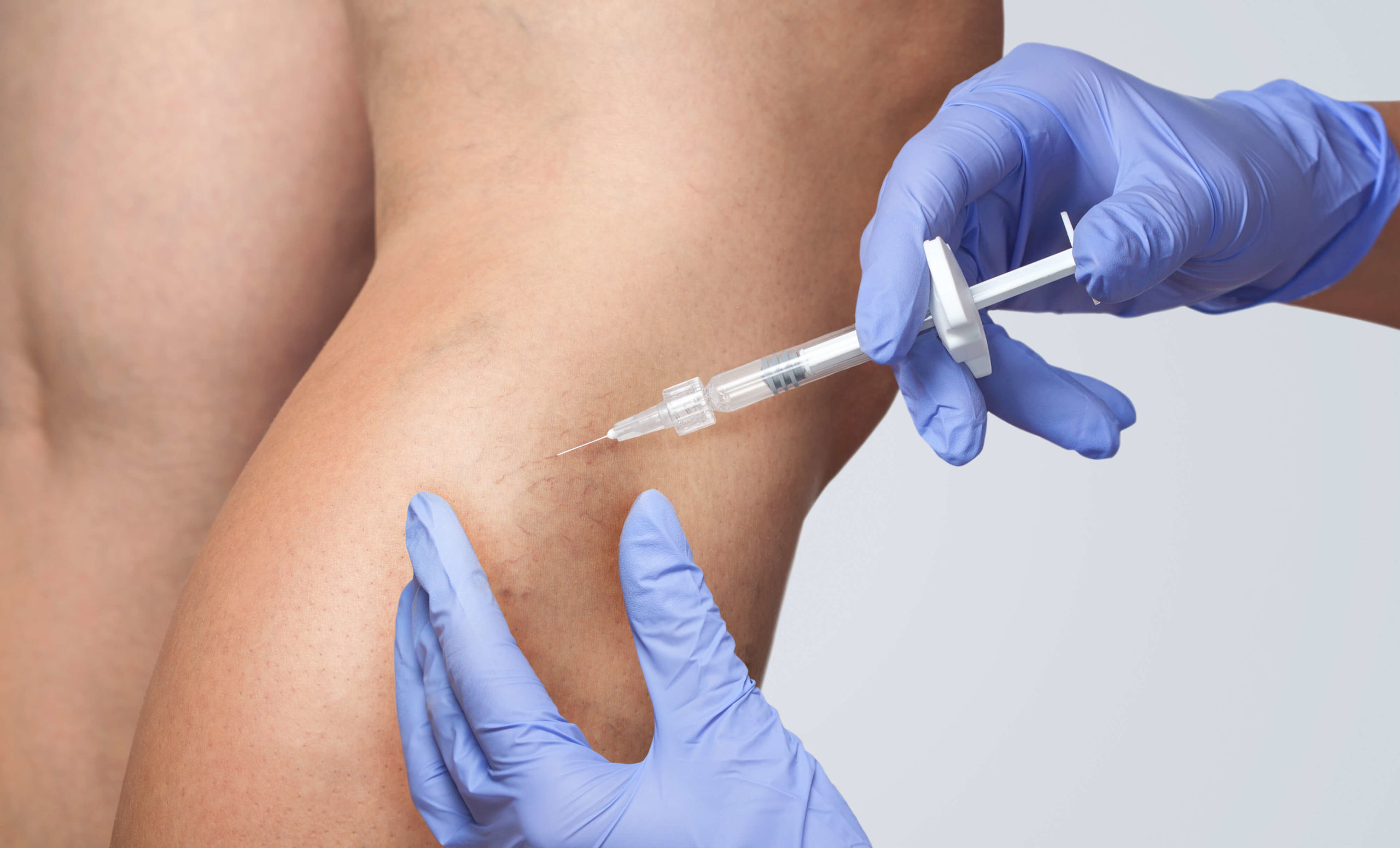 Sclerotherapy Thread Vein Treatment