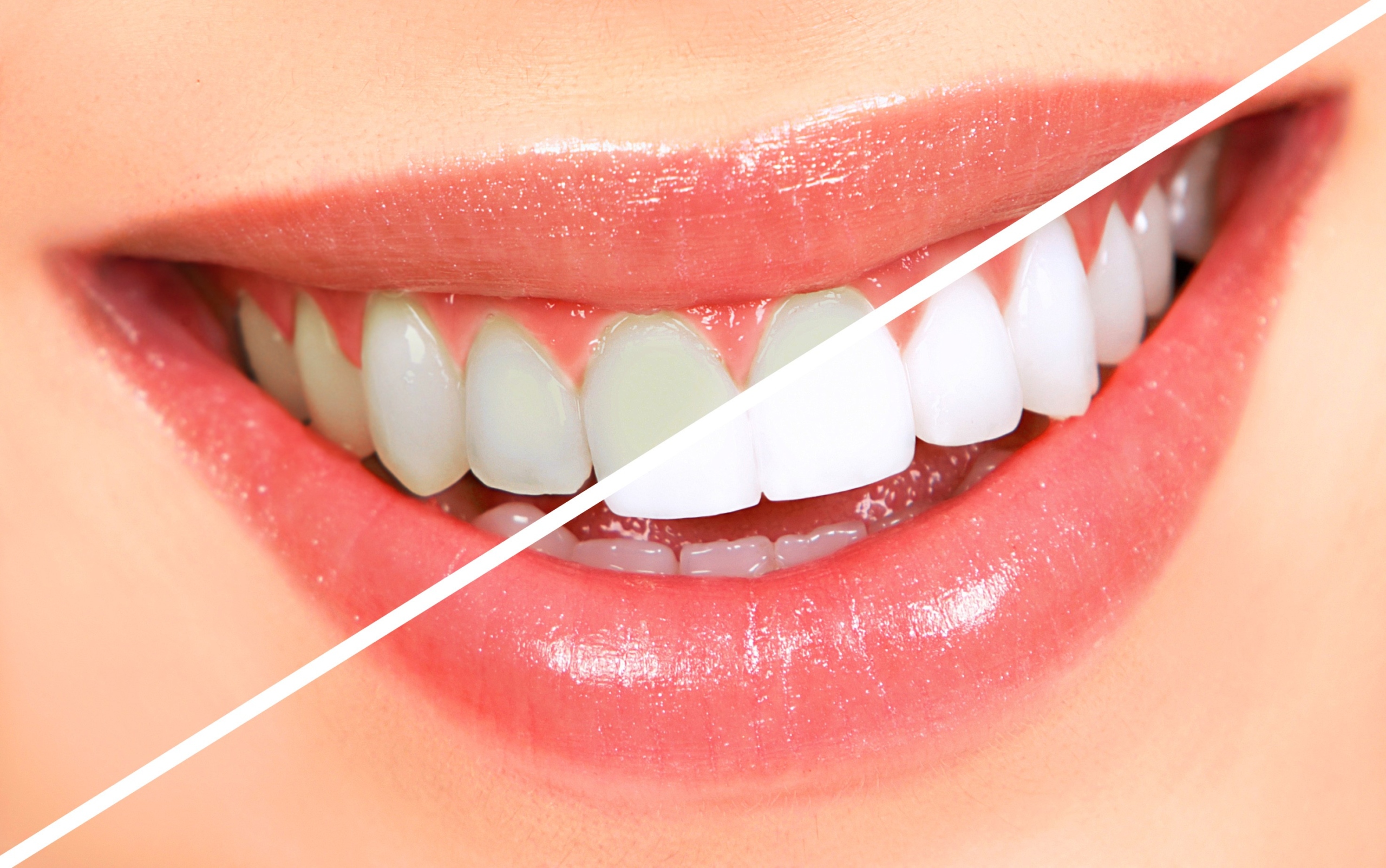 Teeth Whitening at Vilva Cosmetics