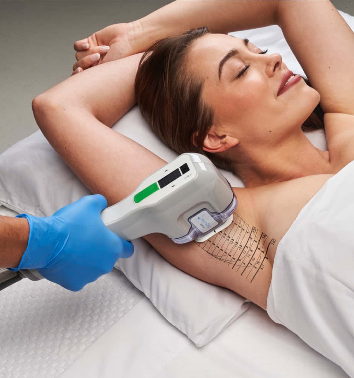 MiraDry Sweat Treatment