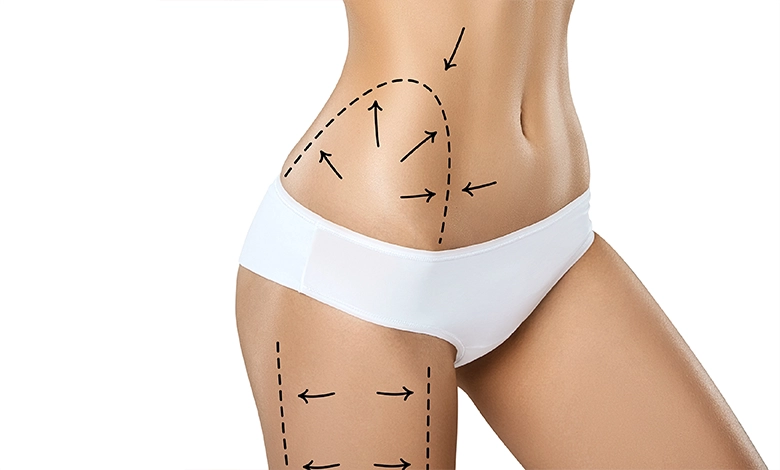 Vaser Liposuction