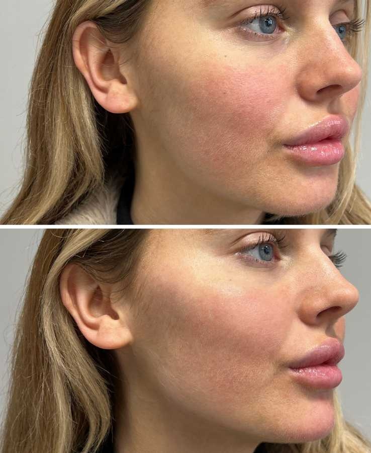 Dermal Filler Cheeks