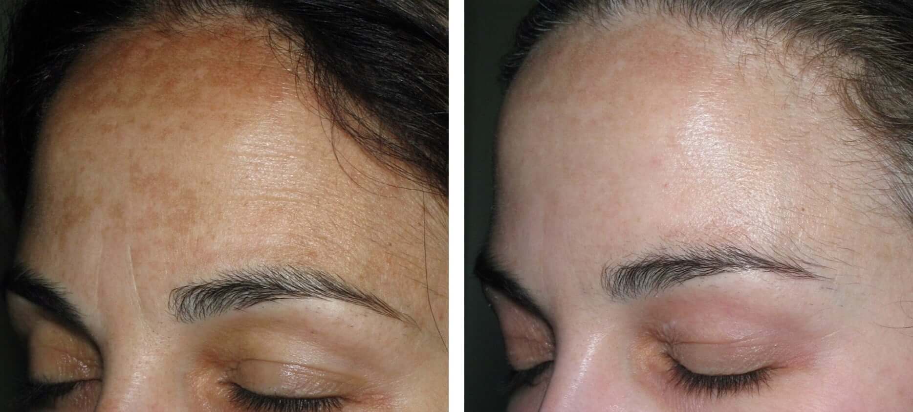Obagi Skin Peel Pigmentation