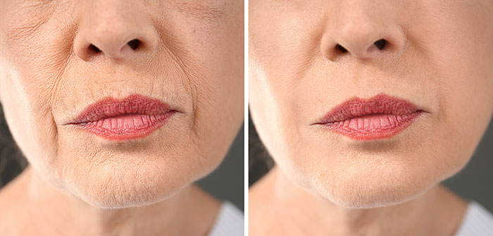 Anti-Wrinkle Before and After 3