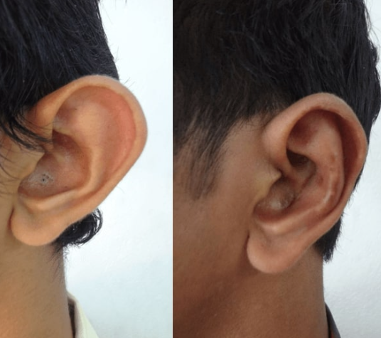 Otoplasty Result