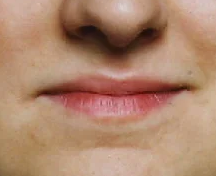 Before Permalip Implant