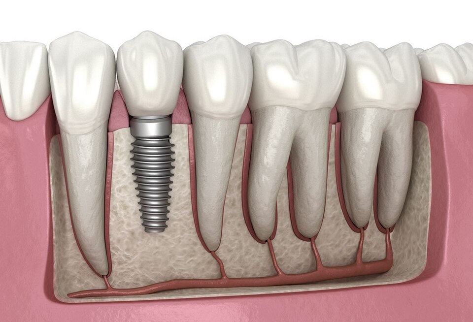 Dental Implants at Vilva Cosmetics