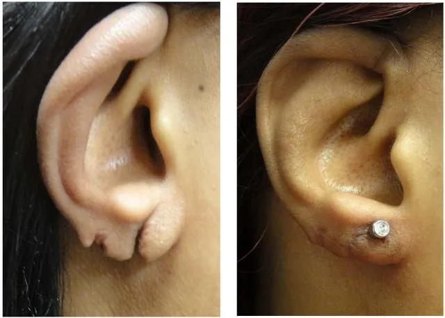 Split Earlobe Repair Result