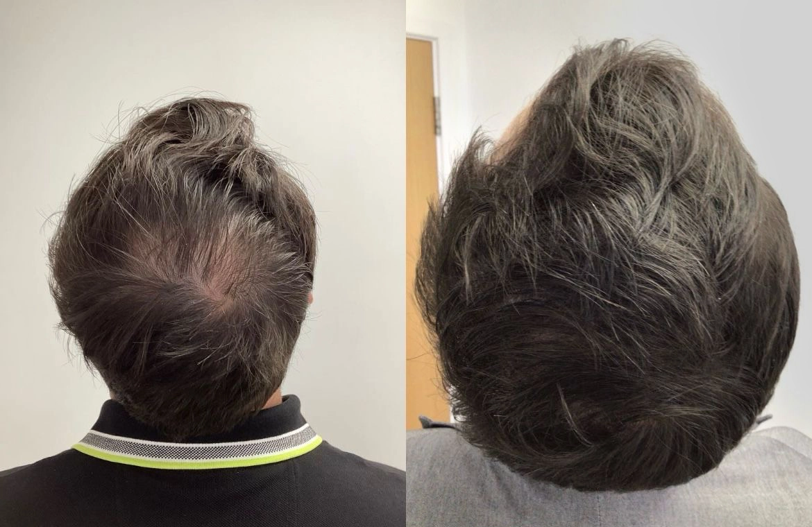Hair Loss Treatment 1