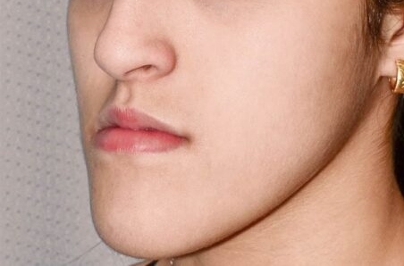 Before Orthognathic Surgery