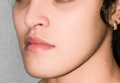 After Orthognathic Surgery