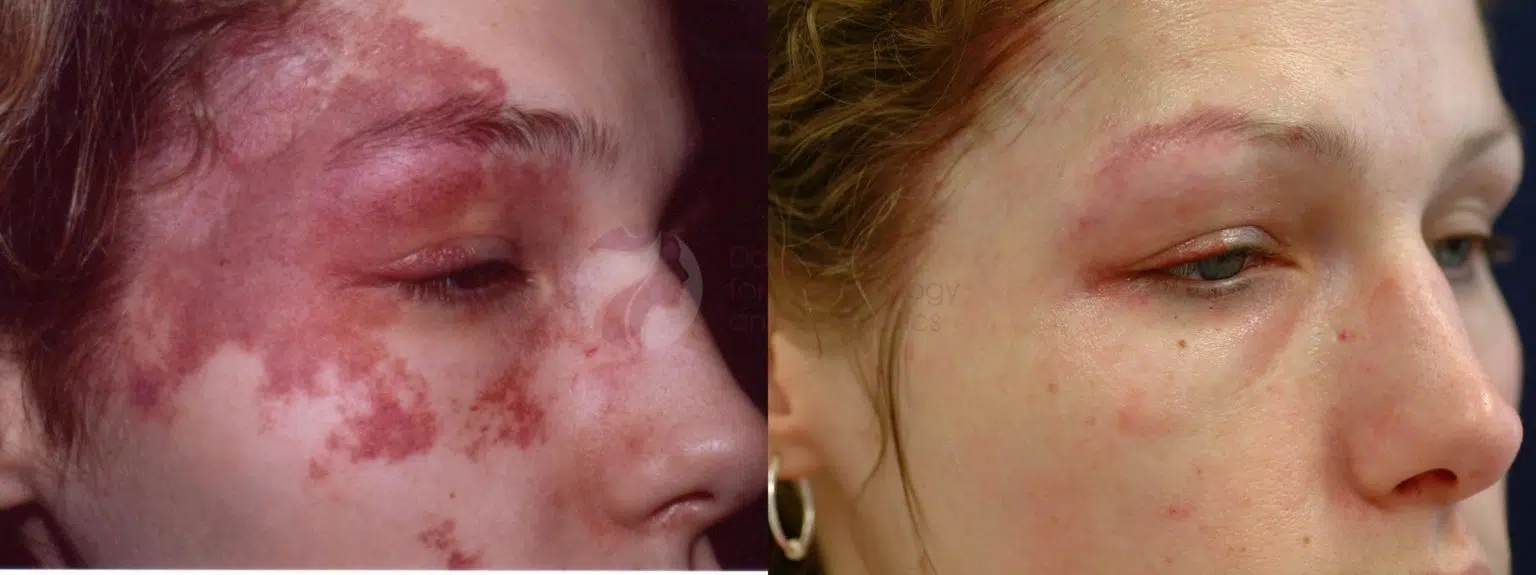 PDL Redness Reduction