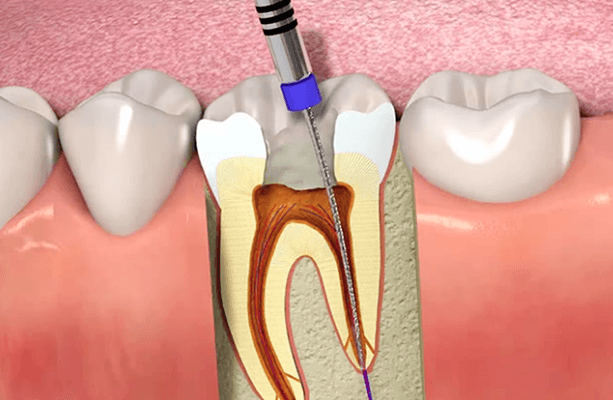 Root Canal Treatment at Vilva Cosmetics