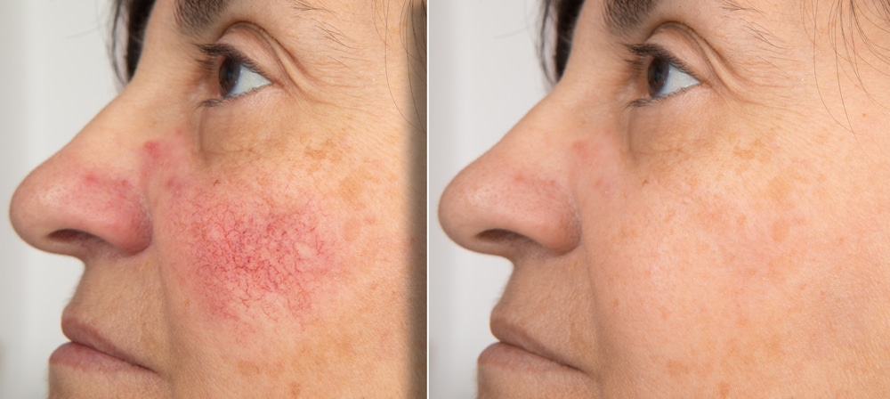 PDL Rosacea Improvement