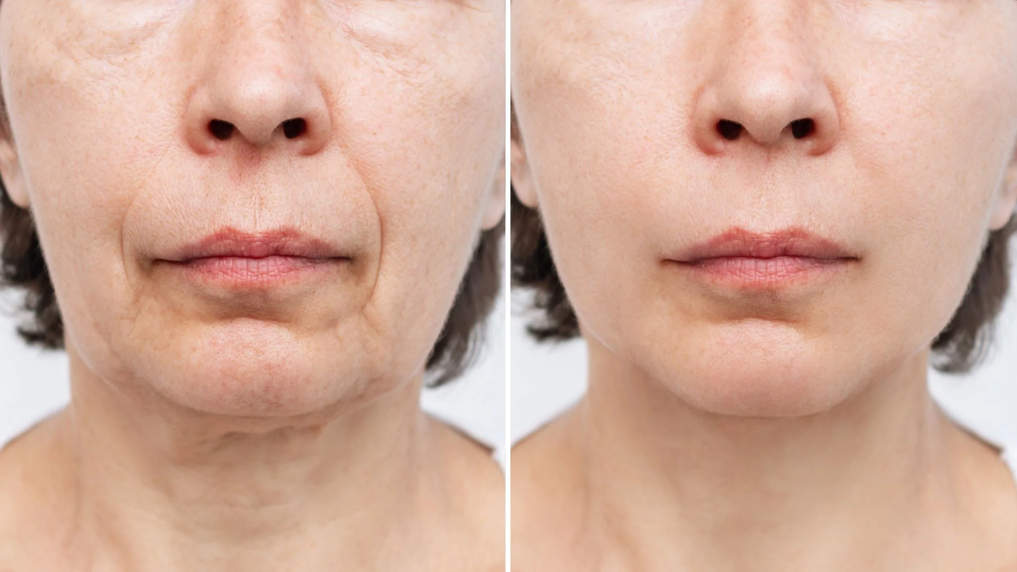 Collagen Boosting Before and After 2
