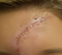 Before Scar Revision