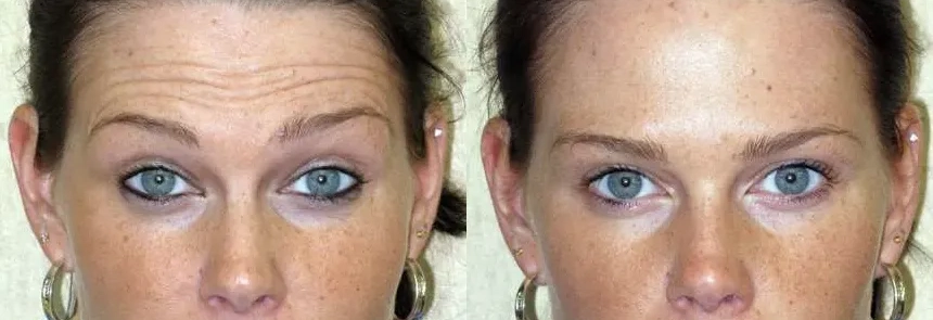 Anti-Wrinkle Before and After 1
