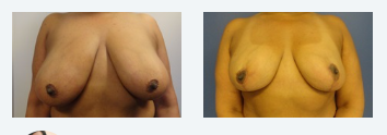 Breast Reduction Before 1