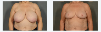 Breast Reduction After 1