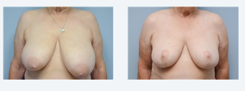 Breast Reduction Before 2