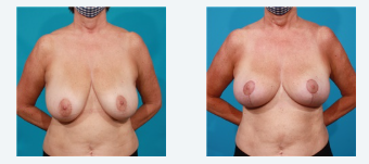 Breast Reduction After 2