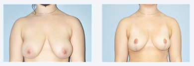 Breast Reduction Combo