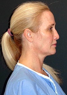 Before One-Stitch Mini Facelift