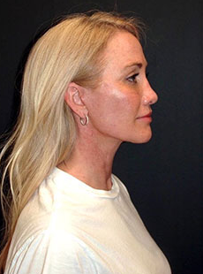 After One-Stitch Mini Facelift