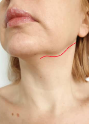 Before Two-Stitch Mini Facelift