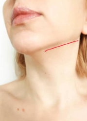 After Two-Stitch Mini Facelift