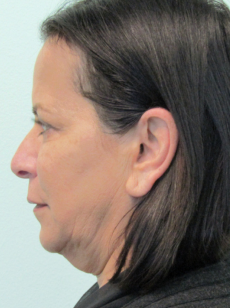 Before Neck Lift