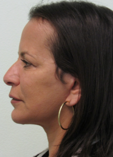 After Neck Lift