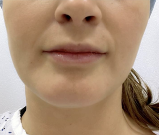 Before Buccal Fat Removal