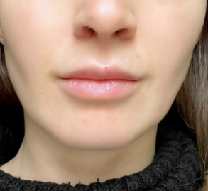 After Buccal Fat Removal