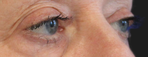 Before Blepharoplasty