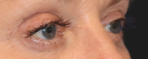 After Blepharoplasty