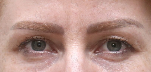Before Brow Lift