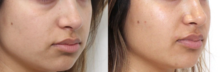 Cheek Reshaping Result