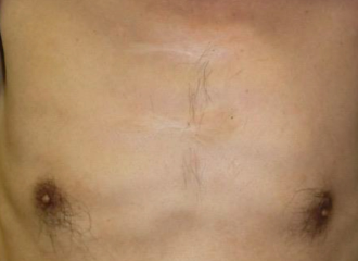 After Scar Treatment