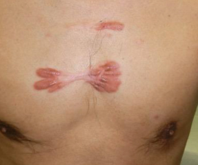 Before Scar Treatment