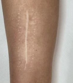 After Tattoo Removal